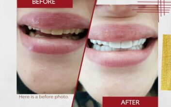 How The Benefits From Snap On Veneers Can Change Your Life